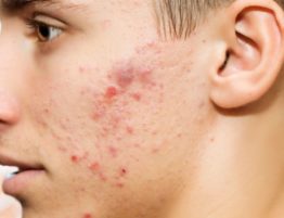 Close-up of acne on a person's face